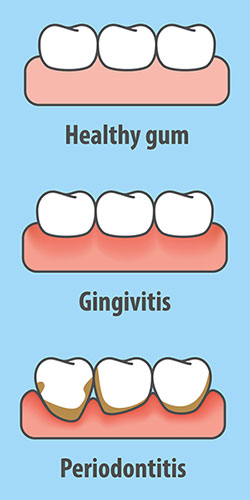 stages of gum disease from gingivitis to periodontitis