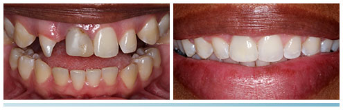 smile transformation with orthodontics and cosmetic dental bonding