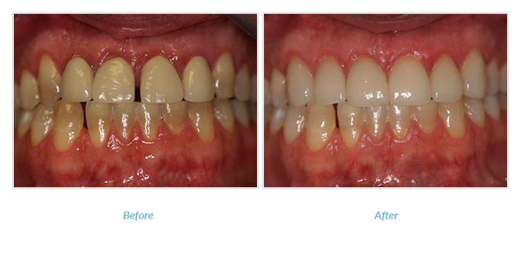 patient before and after porcelain crowns