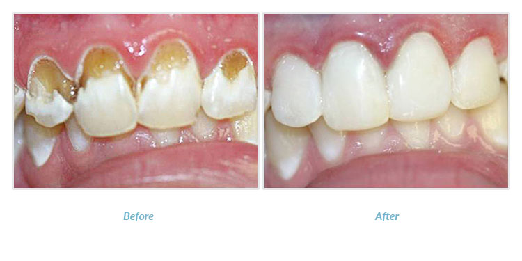 patient before and after cosmetic dental bonding