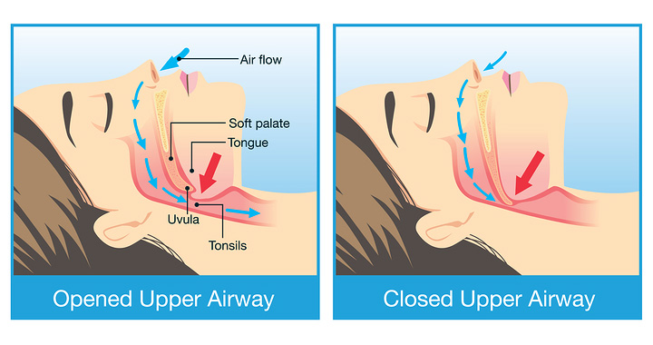 restricted upper airway during sleep